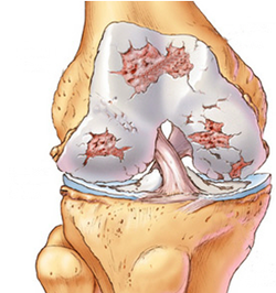 Schaubild Arthrose