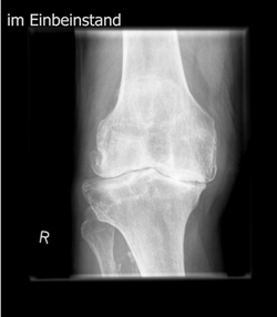 Arthrose im Röntgenbild